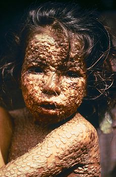 Girl infected with smallpox. Bangladesh, 1973.